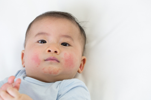 Điểm danh các bệnh về da trẻ nhỏ thường gặp vào mùa hè và cách phòng tránh hiệu quả