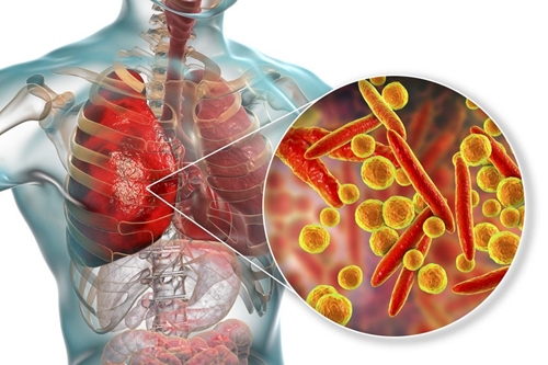 Cảnh báo các dấu hiệu nghi ngờ viêm phổi do vi khuẩn Mycoplasma