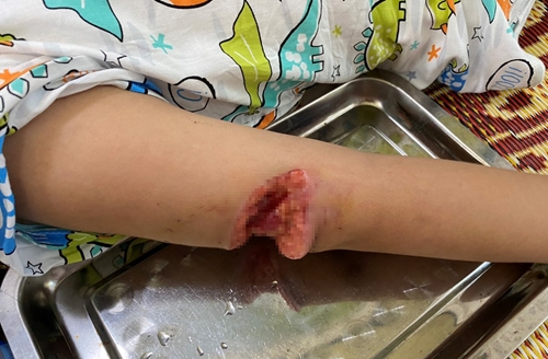 Bé gái 7 tuổi bị chó dữ tấn công, vết thương sâu chạm xương cẳng tay