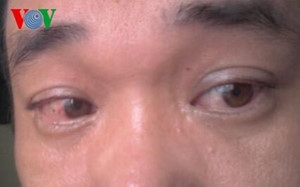 Làm gì để phòng chống dịch bệnh đau mắt đỏ