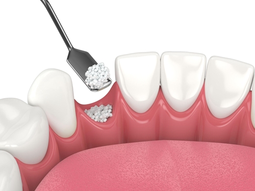 Những điều cần biết khi ghép xương răng trong cấy ghép Implant