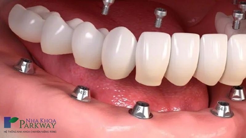 Trồng răng implant ở đâu tốt nhất tại TPHCM